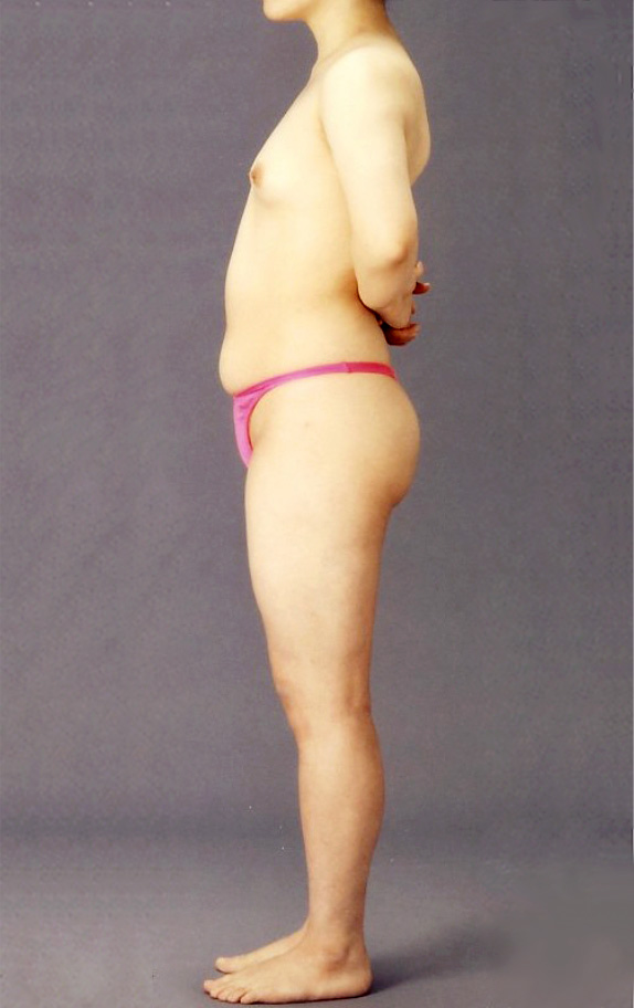 脂肪吸引,ピュアコンデンス脂肪注入豊胸の症例　左右200CCずつ注入、腹部・太腿から脂肪吸引,Before,ba_inject15_b.jpg