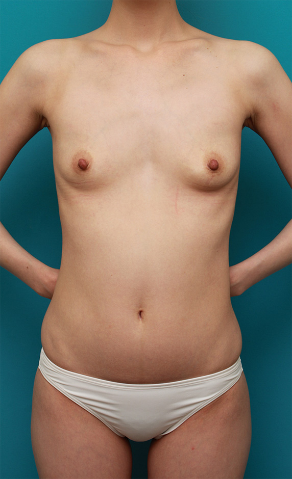 脂肪吸引,ピュアコンデンス脂肪注入豊胸の症例　左右150CCずつ注入、お腹周り太ももから脂肪吸引　乳頭縮小も施行,Before,ba_inject26_b.jpg