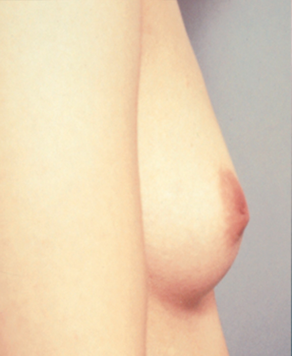 陥没乳頭,陥没乳頭の症例 重度の陥没乳頭だった女性,Before,ba_kanbotsu06_b.jpg