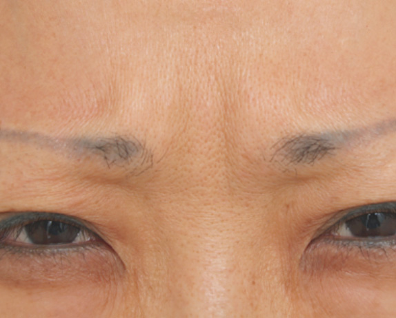 症例写真,注射式シワ取りの症例 ボツリヌストキシン注射　眉間,Before,ba_votox_pic10_b.jpg