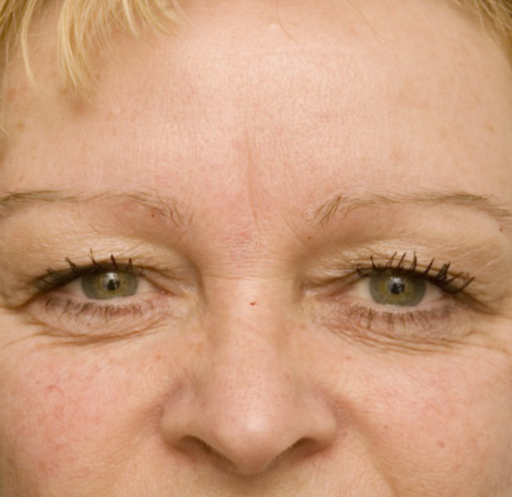 症例写真,注射式シワ取りの症例  長期持続型ヒアルロン酸注入　眉間,Before,ba_hyaluronic_pic17_b.jpg