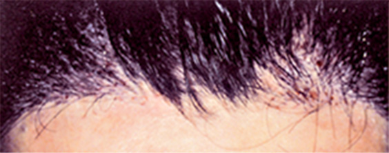 医療植毛,医療植毛 前頭部の生え際、両サイドの後退がお悩みの患者様の症例,After,ba_hair09_a01.jpg