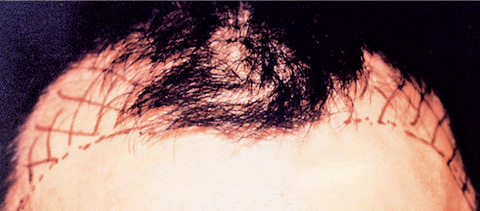 医療植毛,医療植毛 前頭部の生え際、両サイドの後退がお悩みの患者様の症例,植毛部デザイン,mainpic_hair_transplant01b.jpg