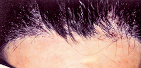 医療植毛,医療植毛 前頭部の生え際、両サイドの後退がお悩みの患者様の症例,さらに300本追加植毛後,mainpic_hair_transplant01e.jpg