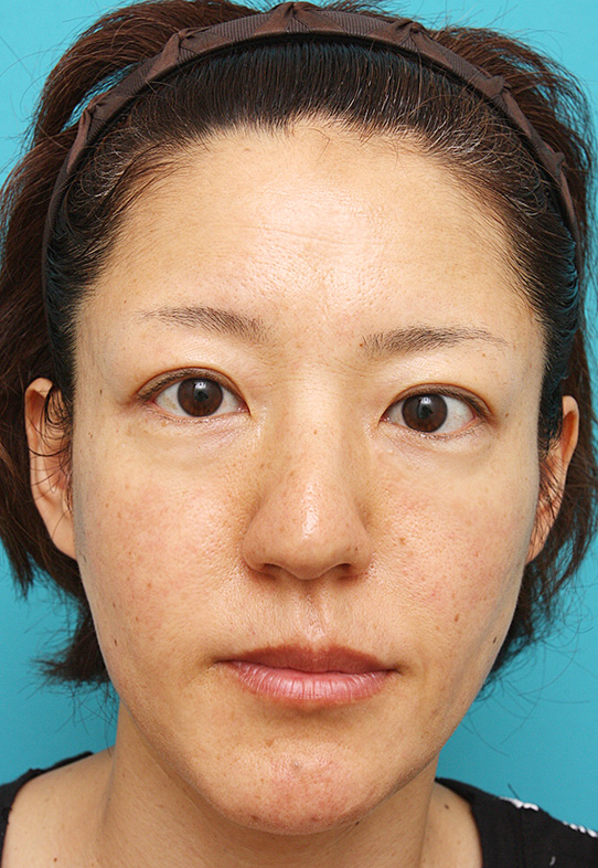 症例写真,注射式シワ取りの症例 長期持続型ヒアルロン酸注入 こけている頬をふっくらさせたい女性,After,ba_hyaluronic_pic32_b.jpg