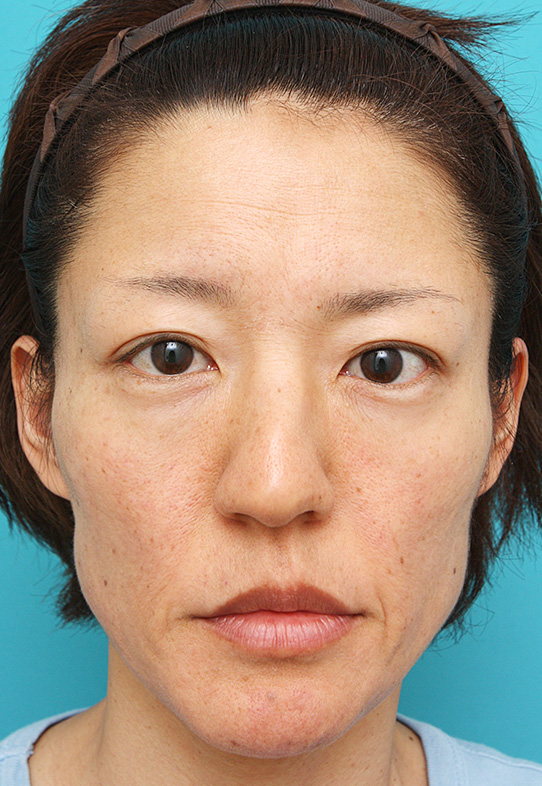 症例写真,注射式シワ取りの症例 長期持続型ヒアルロン酸注入 こけている頬をふっくらさせたい女性,Before,ba_hyaluronic_pic32_b.jpg