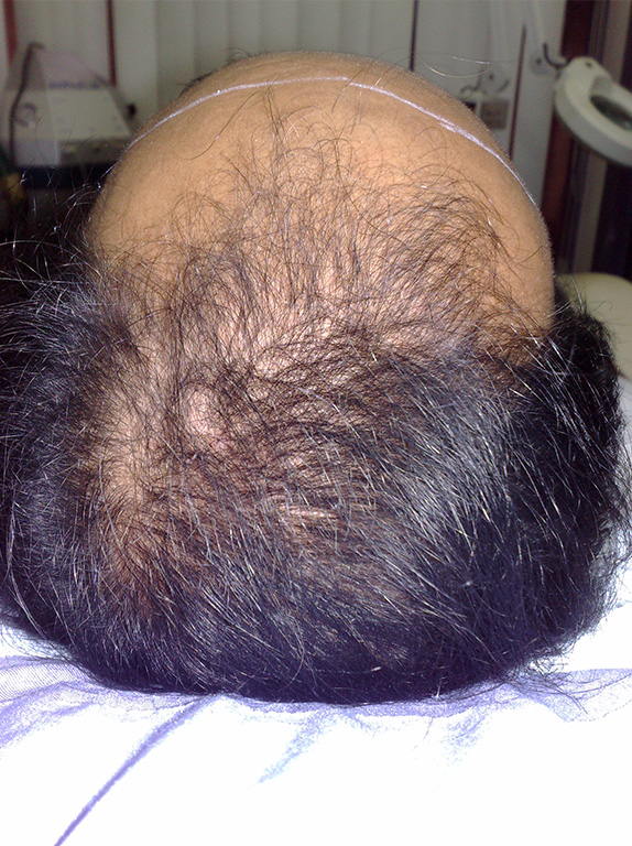 症例写真,AGA治療（高須式メディカル育毛プログラム）の症例写真25　HARG療法を施術,After（6回目施術前）,ba_aga_25_b.jpg