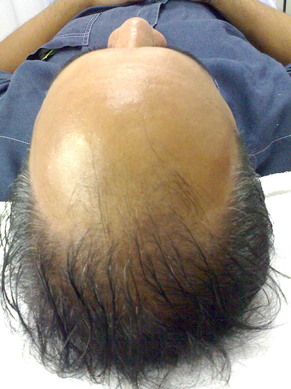 AGA治療（高須式メディカル育毛プログラム）,AGA治療（高須式メディカル育毛プログラム）の症例写真25　HARG療法を施術,Before,ba_aga_25_b.jpg