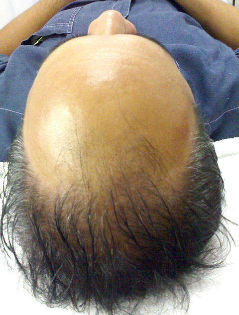 AGA治療（高須式メディカル育毛プログラム）,AGA治療（高須式メディカル育毛プログラム）の症例写真25　HARG療法を施術,HARG療法　施術前,mainpic_aga02a.jpg