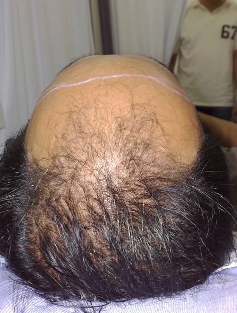 AGA治療（高須式メディカル育毛プログラム）,AGA治療（高須式メディカル育毛プログラム）の症例写真25　HARG療法を施術,4回目施術前,mainpic_aga02b.jpg