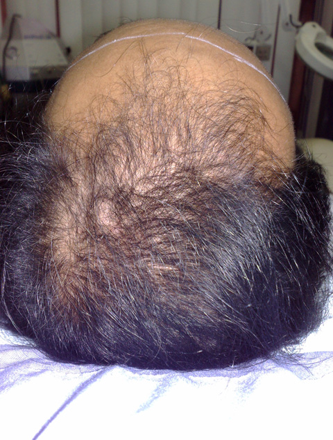 AGA治療（高須式メディカル育毛プログラム）,AGA治療（高須式メディカル育毛プログラム）の症例写真25　HARG療法を施術,6回目施術前,mainpic_aga02c.jpg