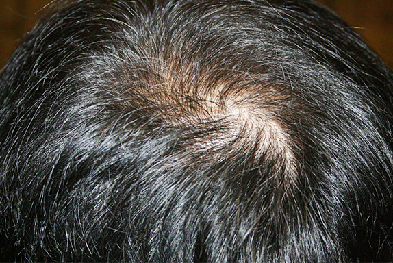 症例写真,AGA治療（高須式メディカル育毛プログラム）の症例写真24　HARG療法を施術,Before,ba_aga_24_b.jpg