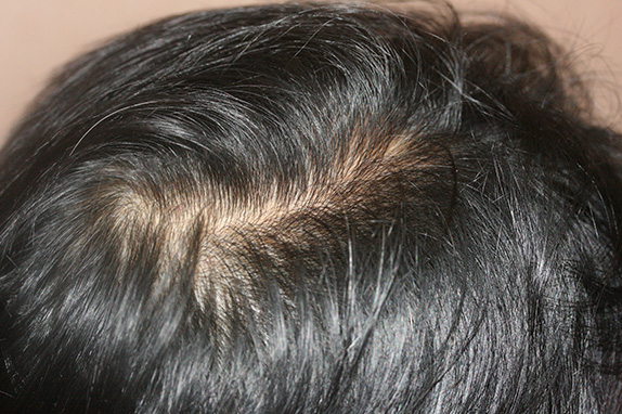 症例写真,AGA治療（高須式メディカル育毛プログラム）の症例写真23　HARG療法を施術,After（14週間後）,ba_aga_23_b.jpg