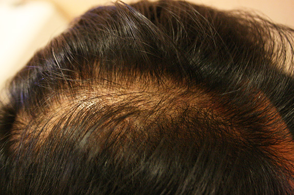 症例写真,AGA治療（高須式メディカル育毛プログラム）の症例写真23　HARG療法を施術,Before,ba_aga_23_b.jpg