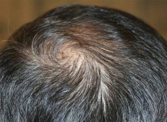 症例写真,AGA治療（高須式メディカル育毛プログラム）の症例写真22　HARG療法を施術,After（12週間後）,ba_aga_22_b.jpg