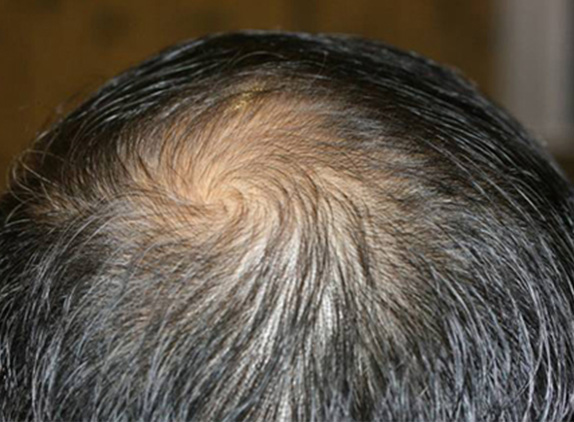 AGA治療（高須式メディカル育毛プログラム）,AGA治療（高須式メディカル育毛プログラム）の症例写真22　HARG療法を施術,Before,ba_aga_22_b.jpg