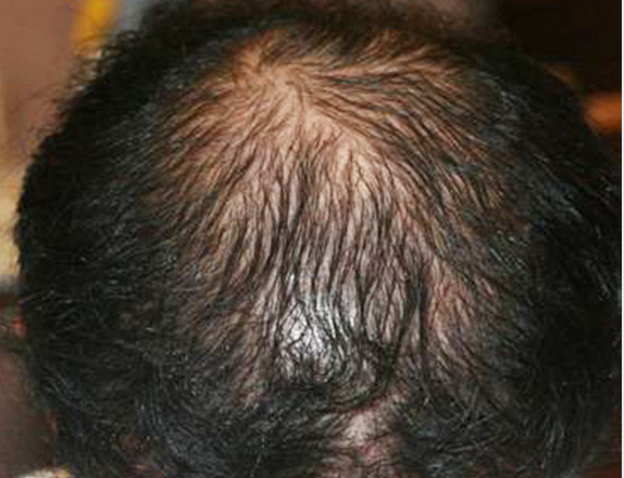 症例写真,AGA治療（高須式メディカル育毛プログラム）の症例写真21　HARG療法を施術,After（12週間後）,ba_aga_21_b.jpg