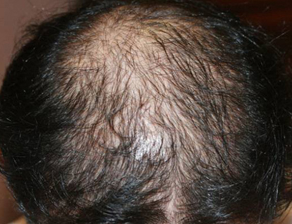 AGA治療（高須式メディカル育毛プログラム）,AGA治療（高須式メディカル育毛プログラム）の症例写真21　HARG療法を施術,Before,ba_aga_21_b.jpg
