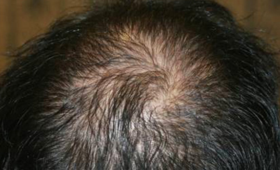 症例写真,AGA治療（高須式メディカル育毛プログラム）の症例写真20　HARG療法を施術,After（12週間後）,ba_aga_20_b.jpg