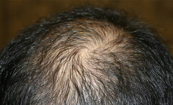 症例写真,AGA治療（高須式メディカル育毛プログラム）の症例写真20　HARG療法を施術,Before,ba_aga_20_b.jpg