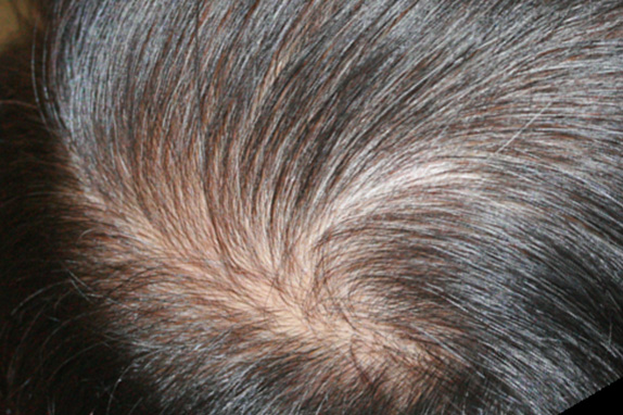 症例写真,AGA治療（高須式メディカル育毛プログラム）の症例写真19　HARG療法を施術,After（18週間後）,ba_aga_19_b.jpg