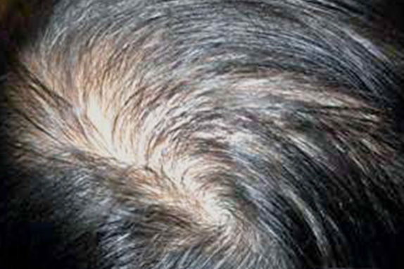 AGA治療（高須式メディカル育毛プログラム）,AGA治療（高須式メディカル育毛プログラム）の症例写真19　HARG療法を施術,Before,ba_aga_19_b.jpg