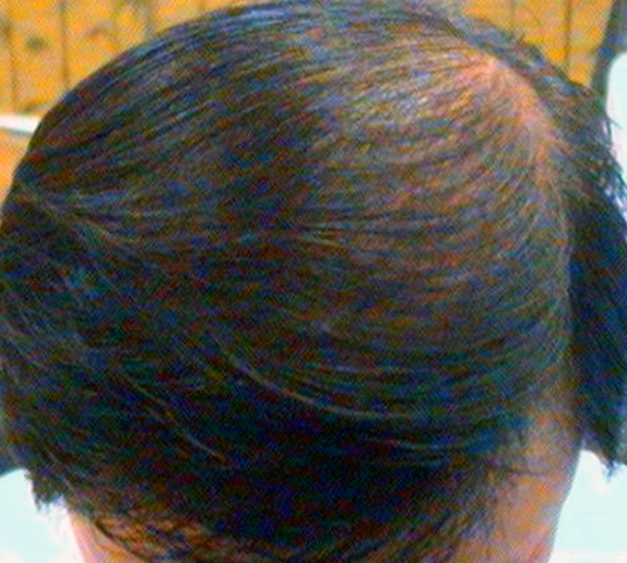 症例写真,AGA治療（高須式メディカル育毛プログラム）の症例写真18　HARG療法を施術,After,ba_aga_18_b.jpg