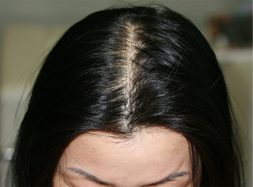 女性の薄毛治療（HARG療法）の症例 HARG療法を5回施術,After（5回施術　5ヶ月後）,ba_aga_15_a01.jpg