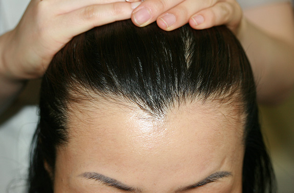 AGA治療（高須式メディカル育毛プログラム）,女性の薄毛治療（HARG療法）の症例 HARG療法を5回施術,After（5回施術　5ヶ月後）,ba_aga_16_b.jpg