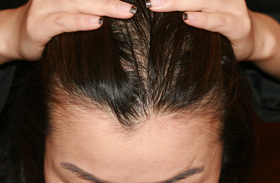 AGA治療（高須式メディカル育毛プログラム）,女性の薄毛治療（HARG療法）の症例 HARG療法を5回施術,Before,ba_aga_16_b.jpg