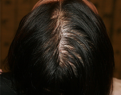 AGA治療（高須式メディカル育毛プログラム）,女性の薄毛治療（HARG療法）の症例 HARG療法を5回施術,Before,ba_aga_17_b.jpg