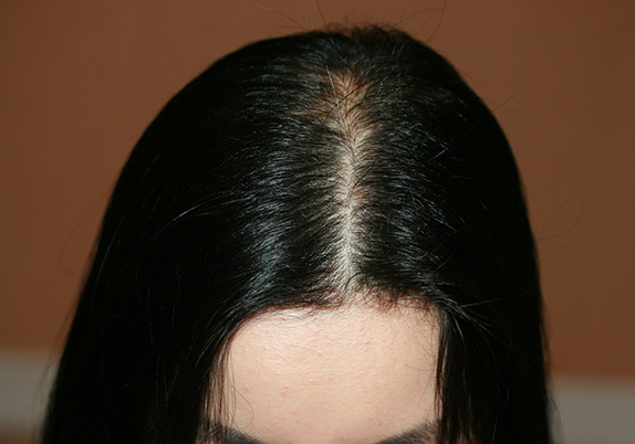女性の薄毛治療,女性の薄毛治療（HARG療法）の症例写真,After（4回施術　6ヶ月後）,ba_aga_12_b.jpg