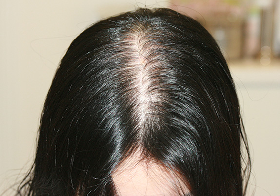 AGA治療（高須式メディカル育毛プログラム）,女性の薄毛治療,女性の薄毛治療（HARG療法）の症例写真,Before,ba_aga_12_b.jpg