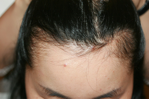 女性の薄毛治療,女性の薄毛治療（HARG療法）の症例写真,After（4回施術　6ヶ月後）,ba_aga_13_b.jpg