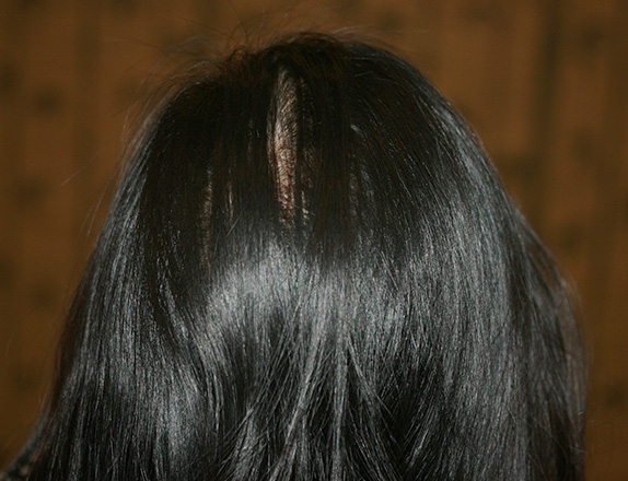 女性の薄毛治療,女性の薄毛治療（HARG療法）の症例写真,After（4回施術　6ヶ月後）,ba_aga_14_b.jpg