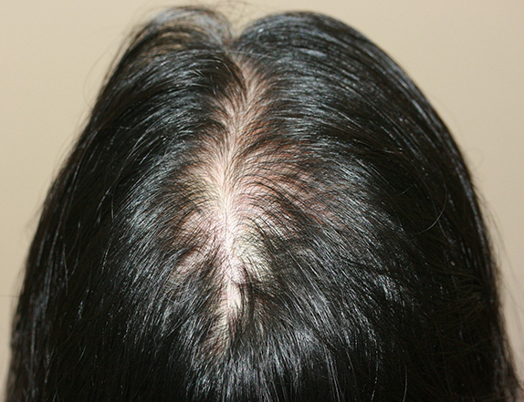 AGA治療（高須式メディカル育毛プログラム）,女性の薄毛治療（HARG療法）の症例写真,Before,ba_aga_14_b.jpg