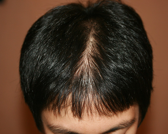AGA治療（高須式メディカル育毛プログラム）,AGA治療（高須式メディカル育毛プログラム）の症例写真９　HARG療法を施術,After（4回施術　4ヶ月後）,ba_aga_09_b.jpg