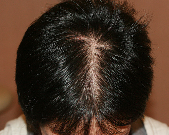 AGA治療（高須式メディカル育毛プログラム）の症例写真９　HARG療法を施術,Before,ba_aga_09_b.jpg