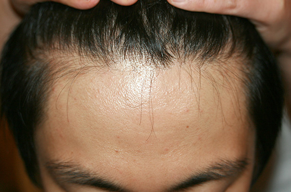 AGA治療（高須式メディカル育毛プログラム）,AGA治療（高須式メディカル育毛プログラム）の症例写真９　HARG療法を施術,After（4回施術　4ヶ月後）,ba_aga_10_b.jpg