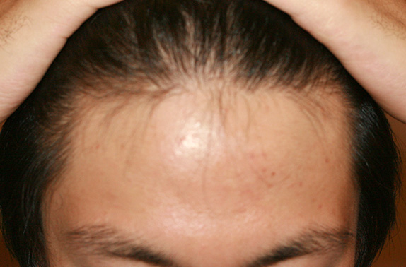 症例写真,AGA治療（高須式メディカル育毛プログラム）の症例写真９　HARG療法を施術,Before,ba_aga_10_b.jpg