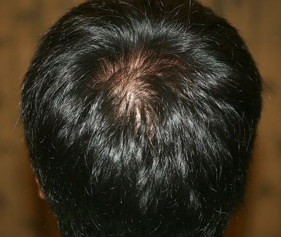 AGA治療（高須式メディカル育毛プログラム）,AGA治療（高須式メディカル育毛プログラム）の症例写真９　HARG療法を施術,After（4回施術　4ヶ月後）,ba_aga_11_b.jpg