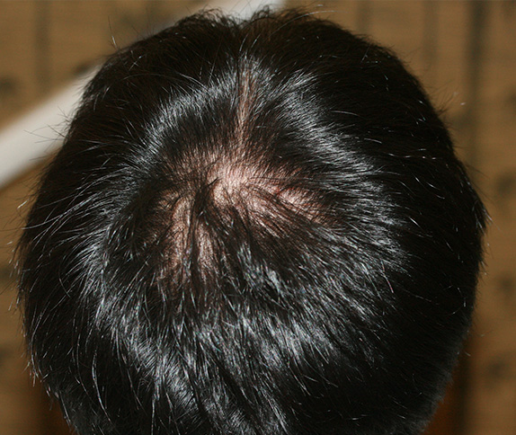 AGA治療（高須式メディカル育毛プログラム）,AGA治療（高須式メディカル育毛プログラム）の症例写真９　HARG療法を施術,Before,ba_aga_11_b.jpg
