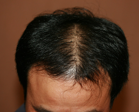 症例写真,AGA治療（高須式メディカル育毛プログラム）の症例写真６　HARG療法を施術,After（6回施術　3ヶ月後）,ba_aga_06_b.jpg