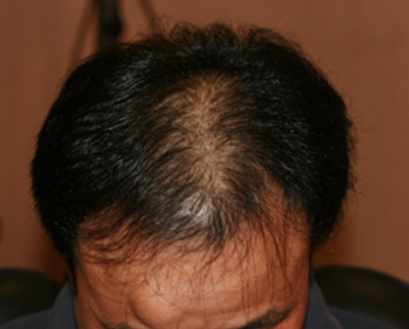 AGA治療（高須式メディカル育毛プログラム）の症例写真６　HARG療法を施術,Before,ba_aga_06_b.jpg