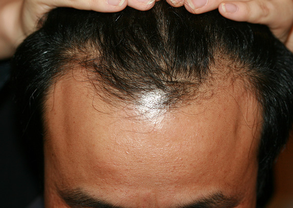 AGA治療（高須式メディカル育毛プログラム）,AGA治療（高須式メディカル育毛プログラム）の症例写真６　HARG療法を施術,After（6回施術　3ヶ月後）,ba_aga_07_b.jpg