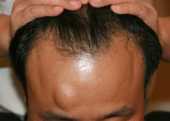 AGA治療（高須式メディカル育毛プログラム）,AGA治療（高須式メディカル育毛プログラム）の症例写真６　HARG療法を施術,Before,ba_aga_07_b.jpg