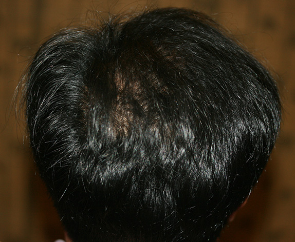 AGA治療（高須式メディカル育毛プログラム）,AGA治療（高須式メディカル育毛プログラム）の症例写真６　HARG療法を施術,After（6回施術　3ヶ月後）,ba_aga_08_b.jpg