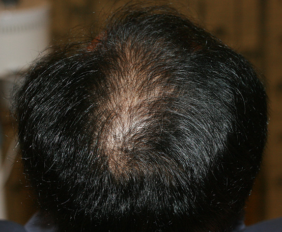 AGA治療（高須式メディカル育毛プログラム）,AGA治療（高須式メディカル育毛プログラム）の症例写真６　HARG療法を施術,Before,ba_aga_08_b.jpg