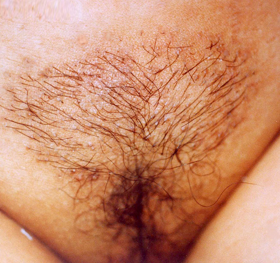 性毛（陰毛）植毛の症例 生まれつきの薄すぎる体毛にお悩みの女性,After,ba_pubic_hair02_a01.jpg