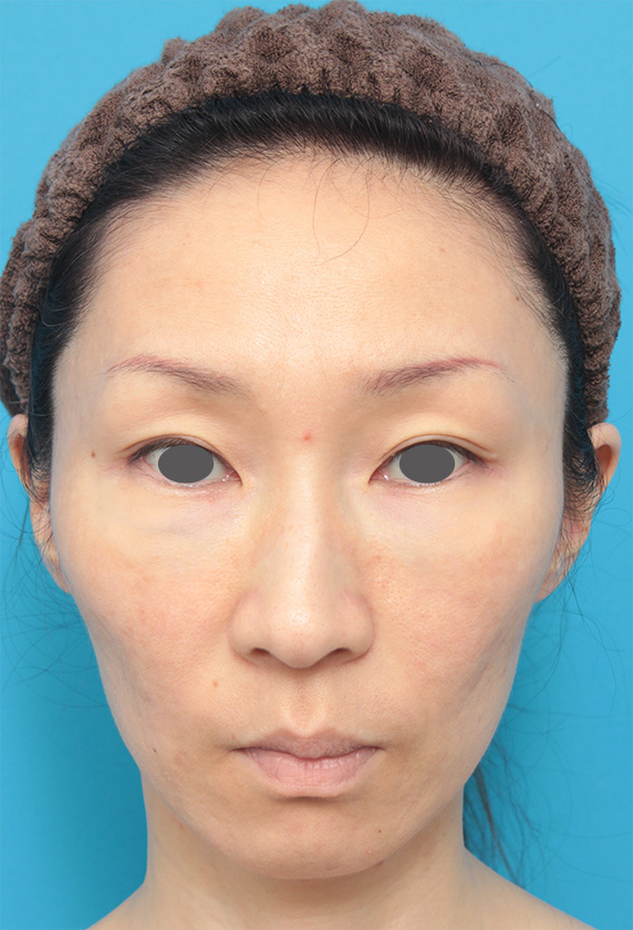 頬をふっくら・ヒアルロン酸注射,頬がこけて窪んでいる部分にヒアルロン酸を注射し、張りのある顔になった症例写真の画像,Before,ba_hyaluronic27_b.jpg